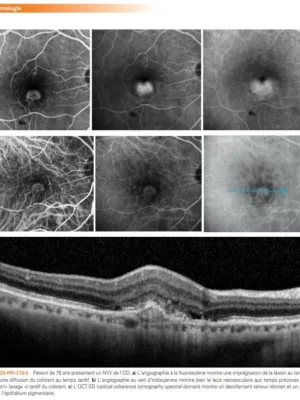  Pathologie de la rétine 