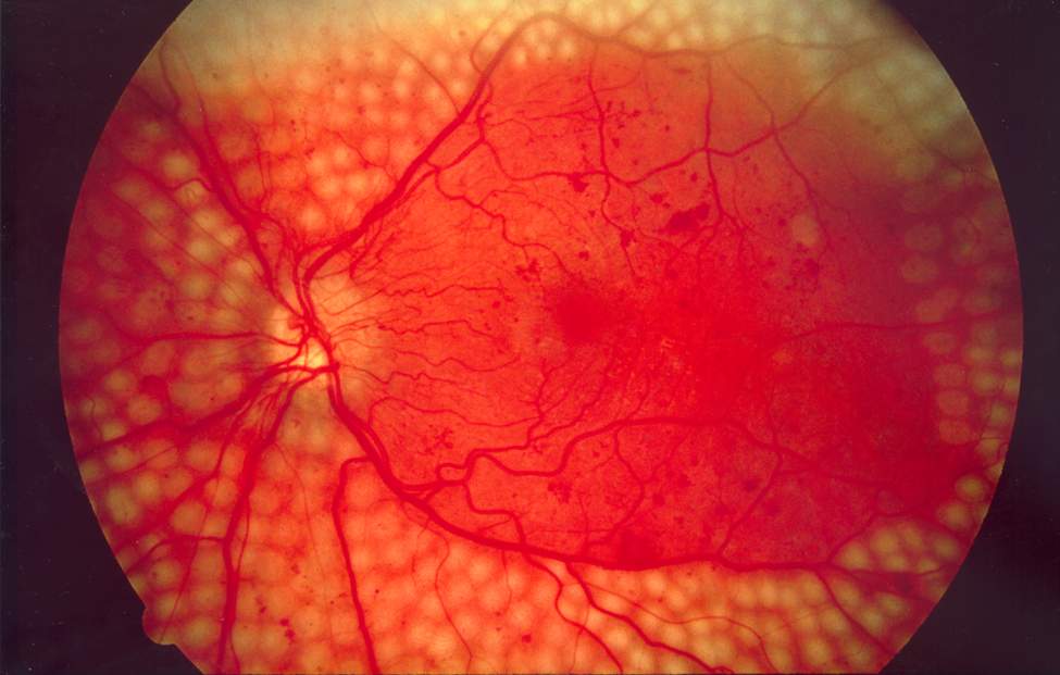 Photo du fond d’œil montrant une photocoagulation au laser panrétinienne pour une rétinopathie diabétique