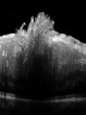  OCT du segment postérieur dans les pathologies chirurgicales 